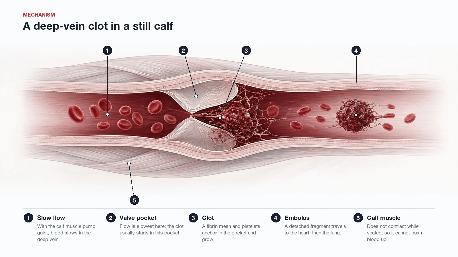 Deep calf vein in long section: slowed flow, a clot forming in the valve pocket, and a fragment travelling towards the lung